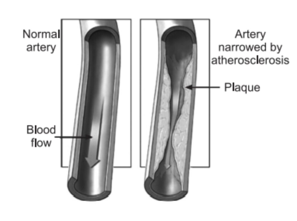 Arteriosclerosis vs Atherosclerosis What distinguishes