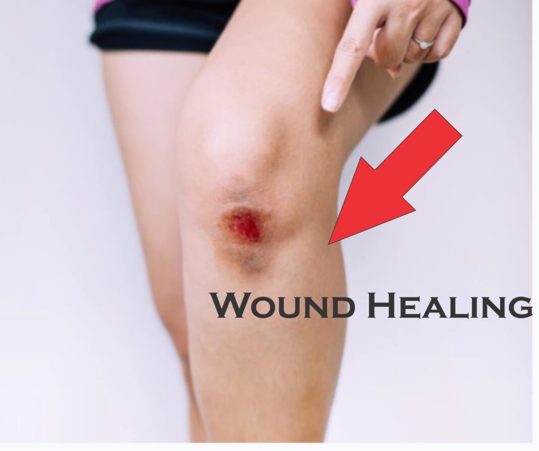 stages of wound healing , wound healing, by his wounds we are healed, how to heal wounds faster, phases of wound healing , fast healing cream for wounds, tummy tuck wound healing problems, does salt heal wounds, wounded healer archetype, wound healing stages pictures, wound healing cream, do wounds heal faster covered or uncovered, secondary intention wound healing, scratch wound healing assay, wound healing assay analysis, humira and wound healing, cell migration assay wound healing, how much vitamin c for wound healing, wound healing technologies, primary intention wound healing, wound healing ppt, stages of wound healing ppt ,