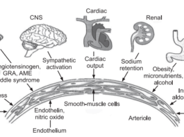 what distinguishes atherosclerosis from arteriosclerosis, atherosclerosis symptoms, atherosclerosis of aorta, atherosclerosis, what is atherosclerosis , atherosclerosis vs arteriosclerosis, atherosclerosis symptoms, how to pronounce atherosclerosis, aortic arch atherosclerosis, multiple sclerosis and atherosclerosis, cerebral atherosclerosis icd 10, atherosclerosis pronunciation, what distinguishes atherosclerosis from arteriosclerosis, atherosclerosis pathology ppt, morphology of atherosclerosis, atherosclerosis pathophysiology ppt, hypertension, high blood pressure symptoms, high bp symptoms, high blood pressure , bp bp, etiology of hypertension, etiology of hypertension blood pressure , arterial hypertension etiology, pathophysiology of hypertension ppt, hypertension pathophysiology, pathophysiology of hypertension, pathophysiology of hypertension slideshare, pathophysiology of hypertension pdf, pregnancy induced hypertension pathophysiology, pulmonary hypertension pathophysiology, pathophysiology of hypertension in flow chart pathophysiology of hypertension flowchart, pathophysiology of htn, pathophysiology of hypertension , pathology of hypertension, Chronic renal failure, Primary hyperaldosteronism Stress, Sleep Apnea, Pheochromocytoma, Preeclampsia, Aortic coarctation,