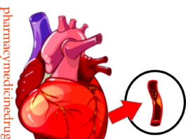 ischaemic heart disease, ischaemic heart disease symptoms, what is ischaemic heart disease, ischaemic heart diseases , ischaemic heart disease life expectancy, ischaemic heart disease medscape, chronic ischaemic heart disease, hypertensive and ischaemic heart disease, fh ischaemic heart disease , causes of ischemic heart disease, coronary heart disease ischemic heart disease, coronary ischemic heart disease , ihd coronary artery disease, ischaemic heart, ischaemic heart diseases , ischemic heart disease, lschemic heart disease, what is ischaemic heart disease , coronary artery disease and ischemic heart disease, ischaemic heart disease nhs, drugs for ischaemic heart disease, how to prevent ischaemic heart disease, ischaemic heart disease facts, what is ischaemic heart disease what causes it, complications of ischaemic heart disease, what does ischaemic heart disease mean, what is ischaemic heart disease what causes it, how to prevent ischaemic heart disease ,