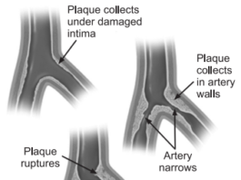 what distinguishes atherosclerosis from arteriosclerosis, atherosclerosis symptoms, atherosclerosis of aorta, atherosclerosis, what is atherosclerosis , atherosclerosis vs arteriosclerosis, atherosclerosis symptoms, how to pronounce atherosclerosis, aortic arch atherosclerosis, multiple sclerosis and atherosclerosis, cerebral atherosclerosis icd 10, atherosclerosis pronunciation, what distinguishes atherosclerosis from arteriosclerosis, atherosclerosis pathology ppt, morphology of atherosclerosis, atherosclerosis pathophysiology ppt what distinguishes atherosclerosis from arteriosclerosis, arteriosclerosis vs atherosclerosis, arteriosclerosis definition, arteriosclerosis, what is arteriosclerosis, what is the impact of arteriosclerosis, what is a possible complication to arteriosclerosis, what is arteriosclerosis, cerebral arteriosclerosis , arteriosclerosis symptoms, compare and contrast arteriosclerosis with atherosclerosis. angioplasty is the most typical treatment for arteriosclerosis, angioplasty is the most typical treatment for arteriosclerosis. arteriosclerosis pronunciation , diferencia entre aterosclerosis y arteriosclerosis, como evitar arteriosclerosis, atherosclerosis vs arteriosclerosis, difference between atherosclerosis and arteriosclerosis , arteriosclerosis obliterans, compare and contrast arteriosclerosis with atherosclerosis , arteriosclerosis and atherosclerosis, difference between arteriosclerosis and atherosclerosis, arteriosclerosis ct, hypertensive arteriosclerosis cardiovascular disease cause of death, can arteriosclerosis be reversed, difference between arteriosclerosis and atherosclerosis , what is the difference between atherosclerosis and arteriosclerosis, what is the difference between arteriosclerosis and atherosclerosis , what is the definition of arteriosclerosis , what does arteriosclerosis mean, arteriosclerosis/atherosclerosis, atherosclerosis arteriosclerosis, arteriosclerosis cardiovascular disease, arteriosclerosis meaning, what is hypertensive arteriosclerosis cardiovascular disease,