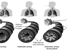 asthma, asthma symptoms, asthma attack, allergic asthma, what is asthma, am i having an asthma attack, what causes asthma, what are symptoms of asthma, is asthma an autoimmune disease, ashma, asmatha, astham, asthema, athsma, asthma medications, symptoms of asthma , asthma icd 10 , asthma inhaler, when was dupixent approved for asthma , second hand smoke asthma , severe asthma actors dupixent commercial actress, can you get asthma from second hand smoke, asthma from secondhand smoke , asthma secondhand smoke, asthma medications dupixent, how bad is smoking with asthma , third hand smoke and asthma , asthma. , dupixent enrollment form asthma, botox and asthma, pneumococcal vaccine asthma, asthma and life insurance , rome allergy and asthma clinic, monoclonal antibody eosinophilic asthma , allergy and asthma lakewood, allergy and asthma waco tx, online asthma prescription, omalizumab asthma , atlanta allergy and asthma hamilton mill , st paul allergy and asthma woodbury, allergy and asthma gainesville ga, advanced allergy and asthma bel air , allergy and asthma plainville ma, asthma and allergy watertown ny , melbourne allergy and asthma, advanced allergy and asthma elgin, allergy and asthma center of corpus christi, canton asthma and allergy, do chihuahuas cure asthma, allergy and asthma center warner robins ga, atlanta allergy and asthma patient portal, allergy and asthma center silver spring, allergy and asthma center shady grove, chicago family asthma and allergy, ketotifen for asthma, lupus and asthma, asthma and lung center, florida lung asthma and sleep specialists poinciana , allergy and asthma center, icd 10 asthma, asthma and allergy center, asthma medications dupixent, how long does it take dupixent to work for asthma, how long for dupixent to work for asthma, dupixent asthma results , dupixent for asthma reviews, dupixent mechanism of action asthma, how fast does dupixent work for asthma, dupixent asthma injection, dupixent dose for asthma, dupixent severe asthma,