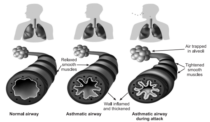 asthma, asthma symptoms, asthma attack, allergic asthma, what is asthma, am i having an asthma attack, what causes asthma, what are symptoms of asthma, is asthma an autoimmune disease, ashma, asmatha, astham, asthema, athsma, asthma medications, symptoms of asthma , asthma icd 10 , asthma inhaler, when was dupixent approved for asthma , second hand smoke asthma , severe asthma actors dupixent commercial actress, can you get asthma from second hand smoke, asthma from secondhand smoke , asthma secondhand smoke, asthma medications dupixent, how bad is smoking with asthma , third hand smoke and asthma , asthma. , dupixent enrollment form asthma, botox and asthma, pneumococcal vaccine asthma, asthma and life insurance , rome allergy and asthma clinic, monoclonal antibody eosinophilic asthma , allergy and asthma lakewood, allergy and asthma waco tx, online asthma prescription, omalizumab asthma , atlanta allergy and asthma hamilton mill , st paul allergy and asthma woodbury, allergy and asthma gainesville ga, advanced allergy and asthma bel air , allergy and asthma plainville ma, asthma and allergy watertown ny , melbourne allergy and asthma, advanced allergy and asthma elgin, allergy and asthma center of corpus christi, canton asthma and allergy, do chihuahuas cure asthma, allergy and asthma center warner robins ga, atlanta allergy and asthma patient portal, allergy and asthma center silver spring, allergy and asthma center shady grove, chicago family asthma and allergy, ketotifen for asthma, lupus and asthma, asthma and lung center, florida lung asthma and sleep specialists poinciana , allergy and asthma center, icd 10 asthma, asthma and allergy center, asthma medications dupixent, how long does it take dupixent to work for asthma, how long for dupixent to work for asthma, dupixent asthma results , dupixent for asthma reviews, dupixent mechanism of action asthma, how fast does dupixent work for asthma, dupixent asthma injection, dupixent dose for asthma, dupixent severe asthma,