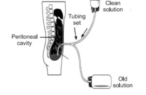 cronic renal failure, what is chronic renal failure, chrinic renal failure, chronic renal failure is a condition that, chronic renal failure definition, what is chronic renal failure, why does chronic renal failure cause proteinuria, which is the leading cause of chronic renal failure quizlet, which of the following does not describe chronic renal failure, what can cause chronic renal failure, chronic renal failure, chronic renal failure diet, chronic renal failure icd 10, icd 10 acute on chronic renal failure, acute on chronic renal failure icd 10, chronic renal failure is a condition that , diet for chronic renal failure, icd 10 code for chronic renal failure, acute on chronic renal failure, chronic renal failure symptoms, chronic renal failure is a condition that quizlet , chronic renal failure is a condition that emt quizlet , which is the leading cause of chronic renal failure quizlet, spontaneous hypoglycemia in chronic renal failure, abbreviation for chronic renal failure , chronic renal failure images , chronic renal failure quizlet, hesi case study chronic renal failure, psychological aspects in chronic renal failure, chronic renal failure nursing diagnosis , nursing diagnosis chronic renal failure, nursing diagnosis for chronic renal failure , dietary teaching for a patient with chronic renal failure, homemade diet for dogs with chronic renal failure, chronic renal failure in cats treatment, difference between acute and chronic renal failure , difference between acute renal failure and chronic renal failure, acute kidney injury vs chronic renal failure, acute vs chronic renal failure, cronic kidney failure, chronic kidney disease and kidney failure, kidney failure chronic, chronic kidney disease ckd, chronic kidney diseases, is chronic kidney disease the same as kidney failure, what is chronic kidney failure, chronic kidney failure, chronic kidney failure medications, chronic kidney failure symptoms, acute on chronic kidney failure icd 10, chronic kidney failure icd 10, chronic kidney failure stage 3 , chronic kidney failure.,