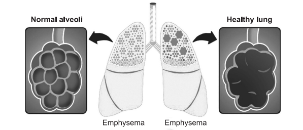 emphysema, subcutaneous emphysema, emphysema symptoms, what is emphysema, emphysema definition, what is emphysema, what causes emphysema, is emphysema cancer, is emphysema copd, what are the 4 stages of emphysema, emfasema, empasima, emphazima, emphazyma, empheysema, emphysema treatment, symptoms emphysema , symptoms of emphysema, centrilobular emphysema, emphysema vs copd, emphysema pronunciation , emphysema slide, pink puffer emphysema, emphysema histology, emphysema quizlet, panlobular emphysema icd 10, the respiratory distress that accompanies emphysema is caused by: , emphysema in spanish , emphysema is characterized by a decrease in quizlet , emphysema 中文, emphysema foundation of america, national emphysema treatment trial, false diagnosis of emphysema , best air purifier for emphysema, emphysema and lung nodules, a 71 year old man with a history of emphysema abdominal emphysema , abdominal wall emphysema, acute bovine pulmonary edema and emphysema, air emphysema dental, polycythemia emphysema, the disease caused by asbestos is emphysema, centrilobular emphysema symptoms, emphysema flare up, what do lung cancer and emphysema have in common, emphysema and lung cancer, emphysema chest x ray, symbicort for emphysema, is emphysema lung cancer, bullous emphysema treatment , is emphysema cancer, paraseptal emphysema, mediastinal emphysema, panlobular emphysema, emphysema x ray, icd 10 emphysema, bullae emphysema, panacinar emphysema, centrilobar emphysema, emphysema in x ray,