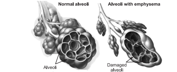 emphysema, subcutaneous emphysema, emphysema symptoms, what is emphysema, emphysema definition, what is emphysema, what causes emphysema, is emphysema cancer, is emphysema copd, what are the 4 stages of emphysema, emfasema, empasima, emphazima, emphazyma, empheysema, emphysema treatment, symptoms emphysema , symptoms of emphysema, centrilobular emphysema, emphysema vs copd, emphysema pronunciation , emphysema slide, pink puffer emphysema, emphysema histology, emphysema quizlet, panlobular emphysema icd 10, the respiratory distress that accompanies emphysema is caused by: , emphysema in spanish , emphysema is characterized by a decrease in quizlet , emphysema 中文, emphysema foundation of america, national emphysema treatment trial, false diagnosis of emphysema , best air purifier for emphysema, emphysema and lung nodules, a 71 year old man with a history of emphysema abdominal emphysema , abdominal wall emphysema, acute bovine pulmonary edema and emphysema, air emphysema dental, polycythemia emphysema, the disease caused by asbestos is emphysema, centrilobular emphysema symptoms, emphysema flare up, what do lung cancer and emphysema have in common, emphysema and lung cancer, emphysema chest x ray, symbicort for emphysema, is emphysema lung cancer, bullous emphysema treatment , is emphysema cancer, paraseptal emphysema, mediastinal emphysema, panlobular emphysema, emphysema x ray, icd 10 emphysema, bullae emphysema, panacinar emphysema, centrilobar emphysema, emphysema in x ray,