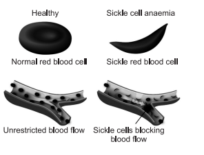 haematological disease, haematological diseases, what is haematological disease, haematological diseases pdf , 5bm045 principles of disease investigation in haematology, hematological diseases , haematologic disorders, hematologic disease, hematologic, hematologic conditions, hematologic disorders , hematological disorders , non cancerous blood disorders , blood cell diseases, blood disorders , hematology , covid 19 updates uk , heamatology , blood disorder, anemia rash , rash with anemia , best blood sample for infectious disease and immuno-haematology , drugs used for haematological diseases, anemia symptoms, anemia complications, anemia treatment, anemia diagnosis, what is anemia,