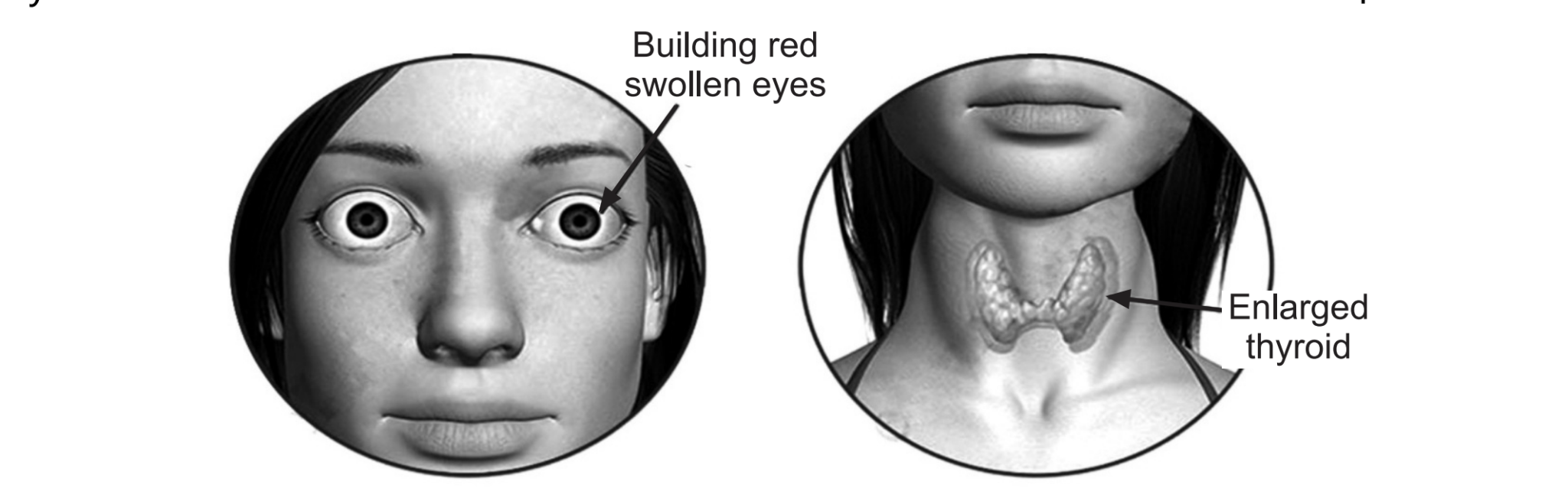 Thyroid Disease What Is Hypothyroidism & Hyperthyroidism Symptoms