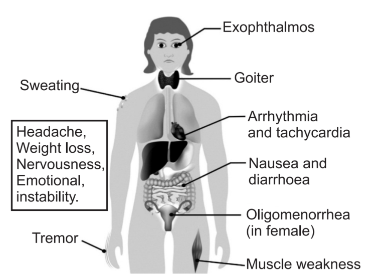 Can Graves Disease Cause Kidney Issues