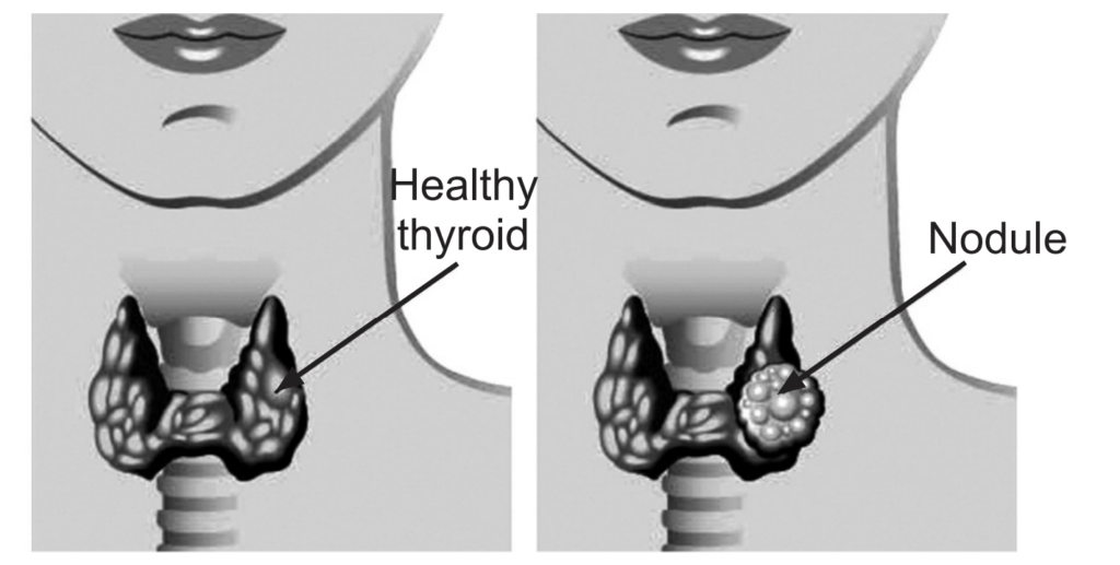 thyroid-cancer-symptoms-treatment-types-thyroid-nodules