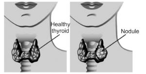 Thyroid Cancer, thyroid cancer symptoms, papillary thyroid cancer, symptoms of thyroid cancer, cancer of thyroid symptoms, what causes thyroid cancer, is thyroid cancer curable, what is thyroid cancer, how long can you have thyroid cancer without knowing, how does thyroid cancer make you feel, throid cancer, thryoid cancer, thuroid cancer, thyoid cancer, thyroid cancwr, medullary thyroid cancer, signs of thyroid cancer, sofia vergara thyroid cancer, thyroid cancer survival rate, thyroid cancer treatment, lobotomy for thyroid cancer, thyroid cancer symbol , jennifer brea thyroid cancer, redifferentiation therapy in thyroid cancer , life insurance for thyroid cancer survivors, sloan kettering thyroid cancer doctor, anaplastic thyroid cancer immunotherap, immunotherapy for anaplastic thyroid cancer , thyroid cancer florida , thyroid and kidney cancer, non hodgkin's lymphoma and thyroid nodules , shape of cancerous thyroid nodules , kidney cancer and thyroid nodules, essential oils for thyroid nodules, afirma test for thyroid nodules , thyroid nodules essential oils, md anderson thyroid nodule clinic, what are the chances of a thyroid nodule being cancerous, thyroid nodules, thyroid nodule, nodules on thyroid, nodule on thyroid, thyroid nodule icd 10 , when to worry about thyroid nodules , thyroid nodule size chart , thyroid nodules symptoms, thyroid nodule symptoms, icd 10 thyroid nodule , thyroid nodule treatment without surgery, icd 10 for thyroid nodule, thyroid nodule icd10 ,