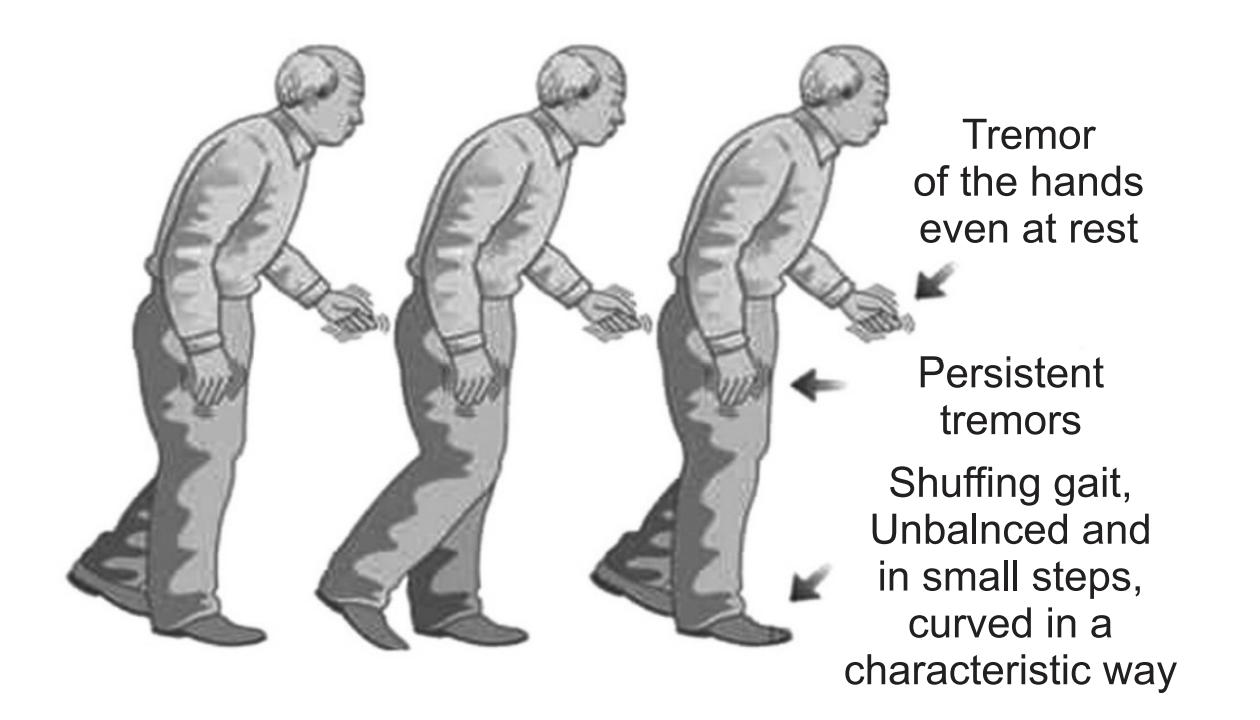 Risk Of Parkinson's Disease In Young Males & Females 