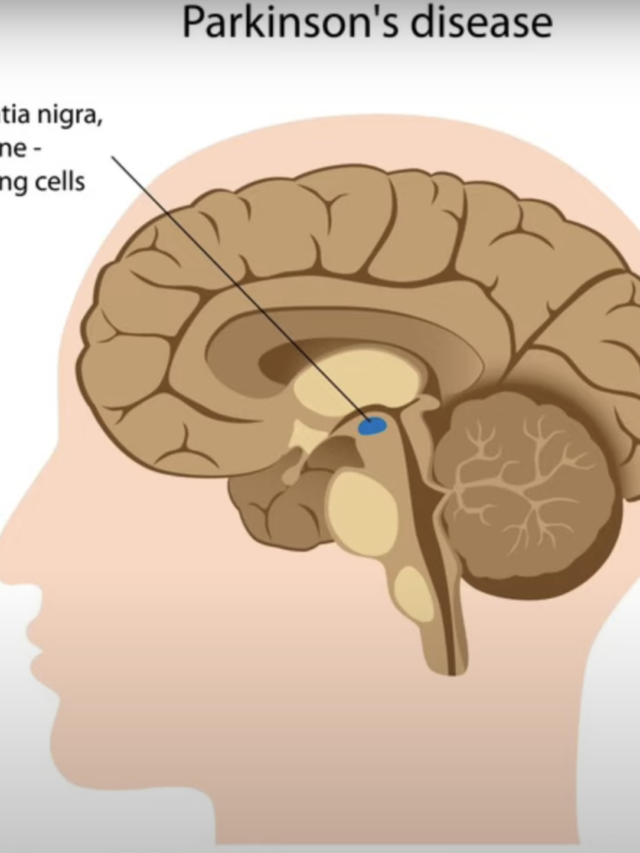 What’s Exactly Is Parkinson’s Disease ?